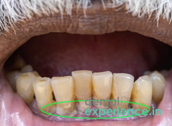 Aged Dark Teeth